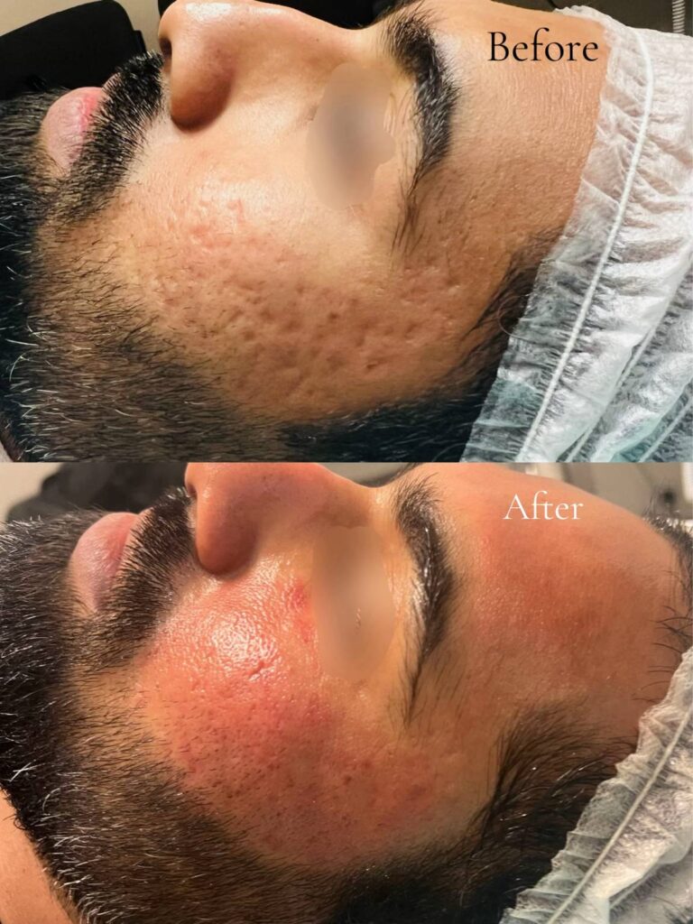 Before and After Subcision Treatment at Paradise Wellness