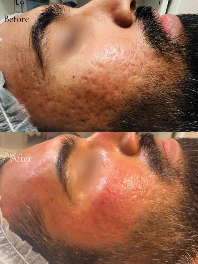 Before and After Subcision Treatment