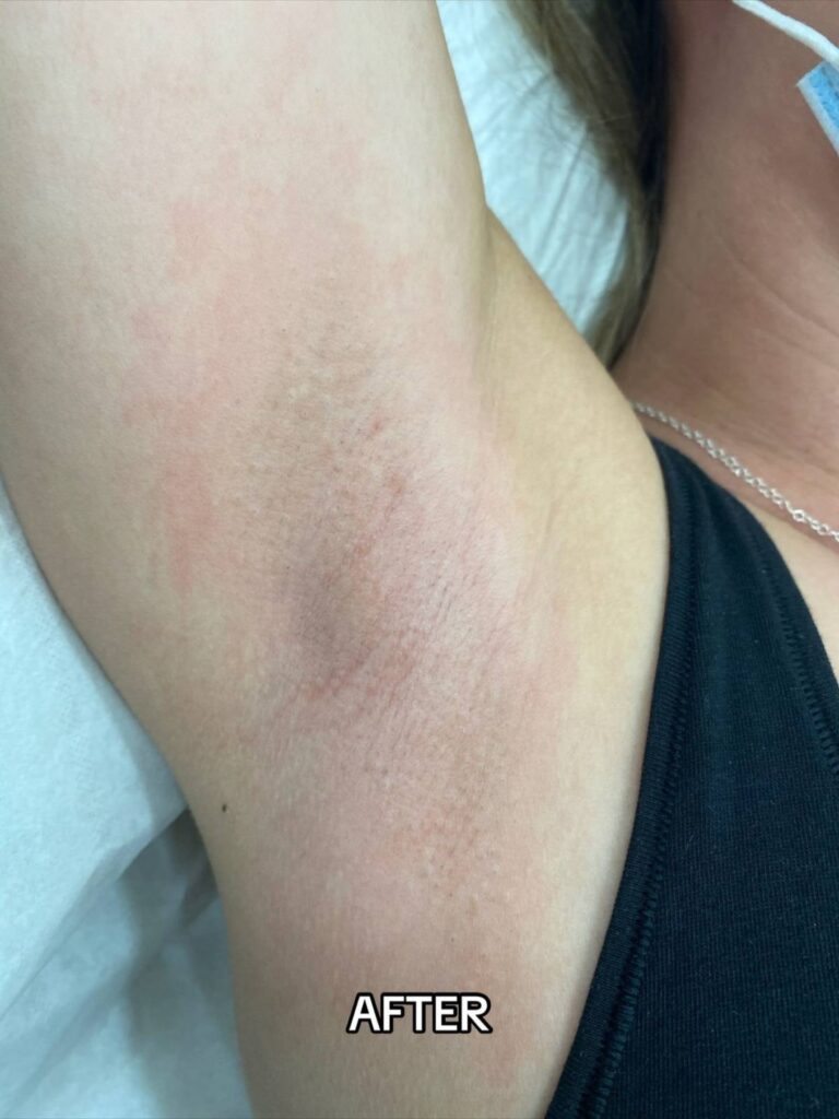 After Laser Hair Removal Side Effects Treatment at Paradise Wellness - Underarm