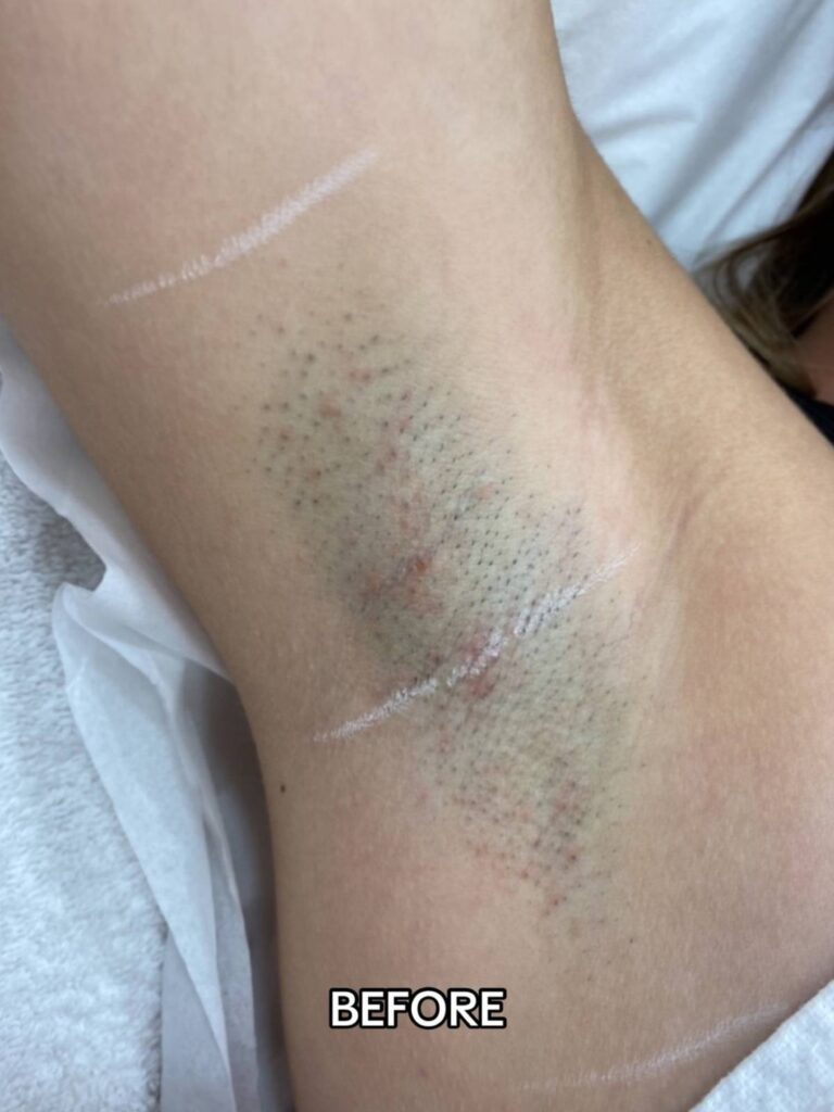 Before Laser Hair Removal Side Effects Treatment at Paradise Wellness - Underarm