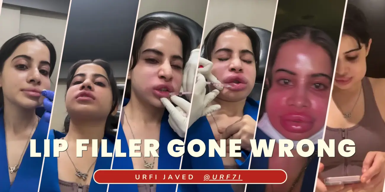 Urfi Javed: Uorfi Javed gets her lip fillers dissolved after 9 years, shares pictures of her swollen face