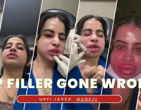 Urfi Javed: Uorfi Javed gets her lip fillers dissolved after 9 years, shares pictures of her swollen face