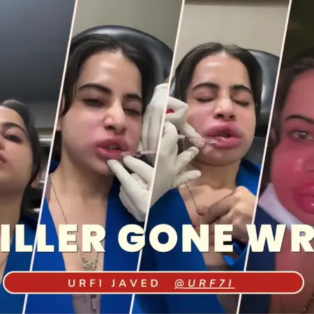 Urfi Javed: Uorfi Javed gets her lip fillers dissolved after 9 years, shares pictures of her swollen face