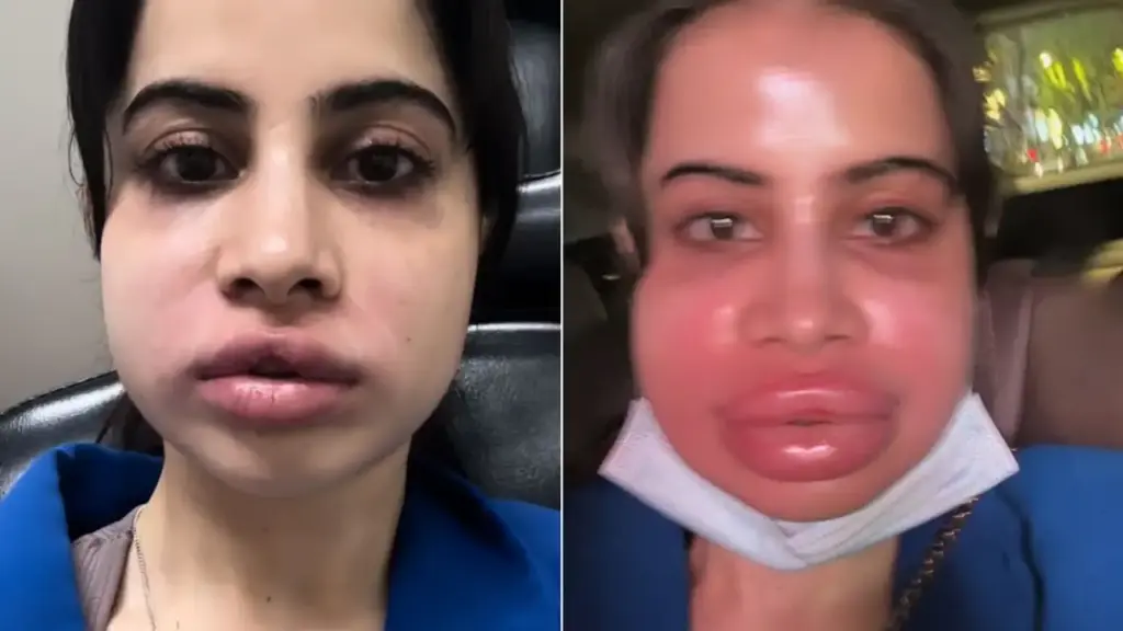 Urfi Javed Lip Filler Gone Wrong Picture from Insta 