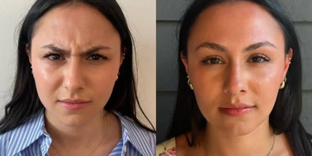 Before and after photos showing Baby Botox results for forehead line treatment in young female patient