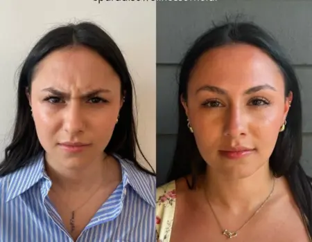 Before and after photos showing Baby Botox results for forehead line treatment in young female patient