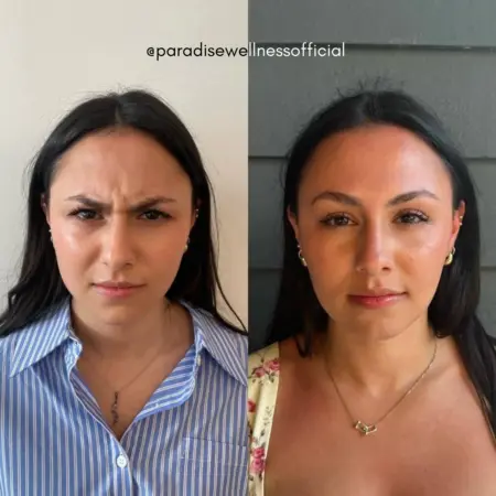 Before and after photos showing Baby Botox results for forehead line treatment in young female patient