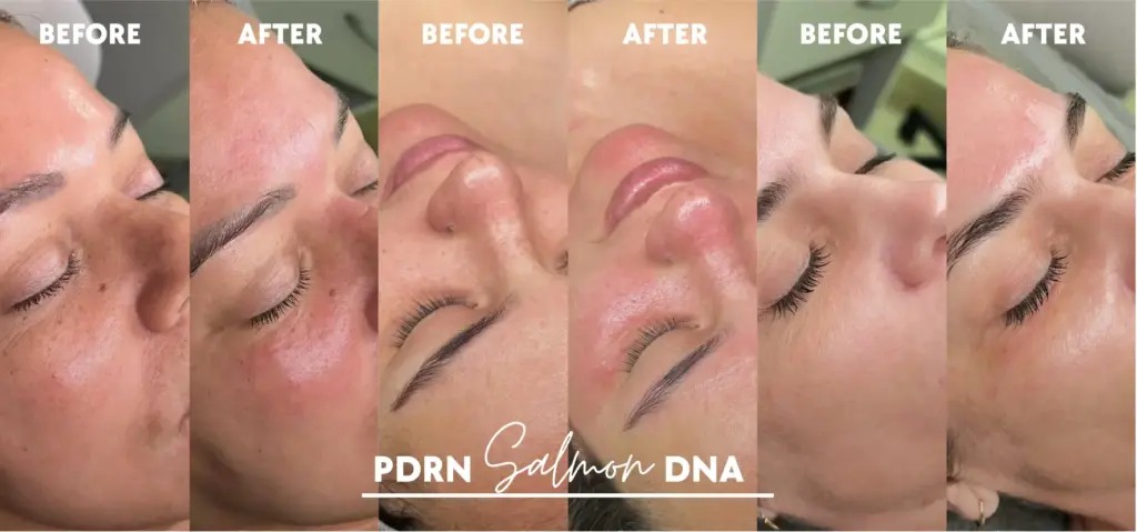 Before and after Salmon DNA PDRN facial results showing improved skin texture, glow, and hydration