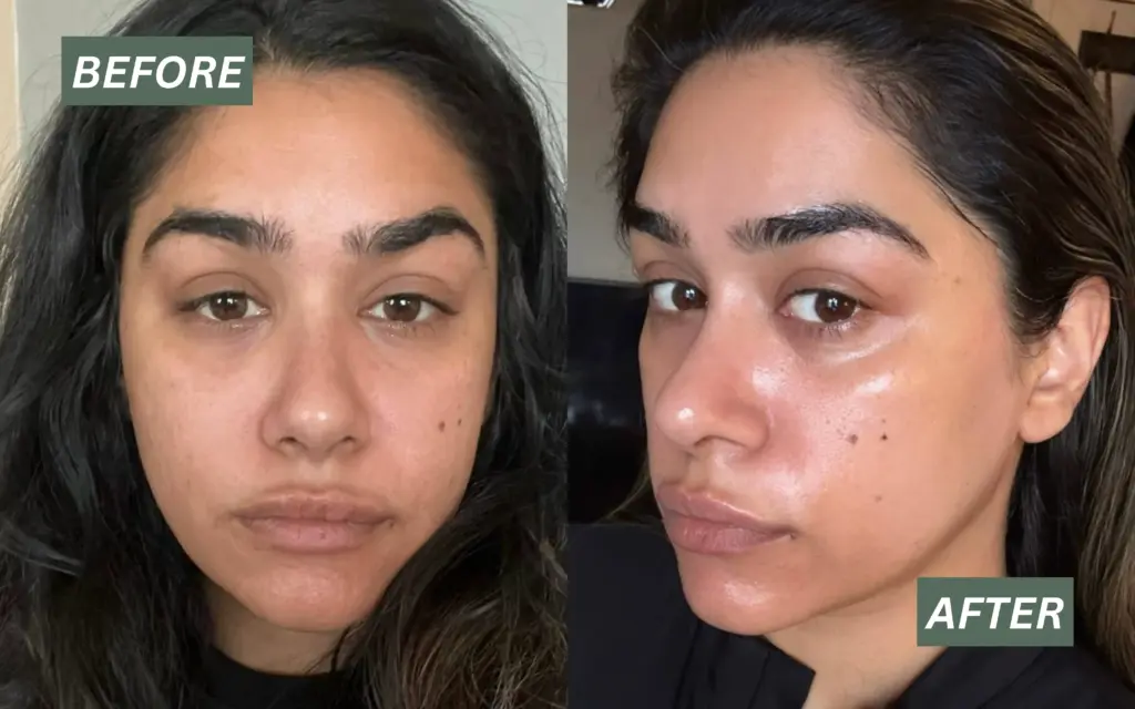 Before and after Skinvive skin booster treatment at Paradise Wellness Clinic, Delhi showing improved skin glow and hydration