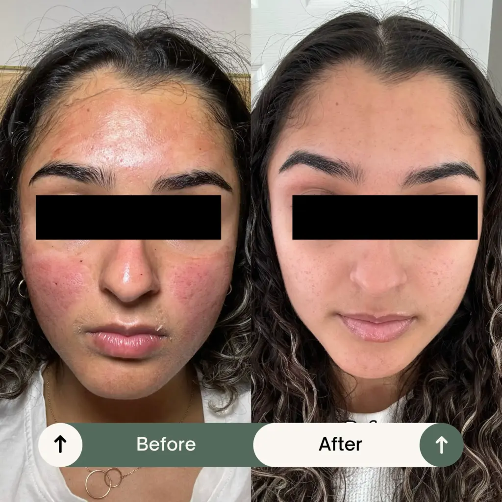 PRF Treatment Result (paradise wellness clinic)