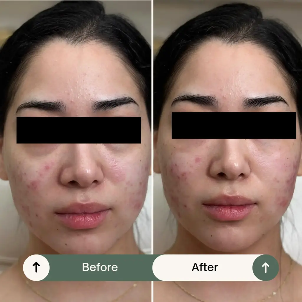 PRF vs PRP see the difference both treatment PRF and PRP 