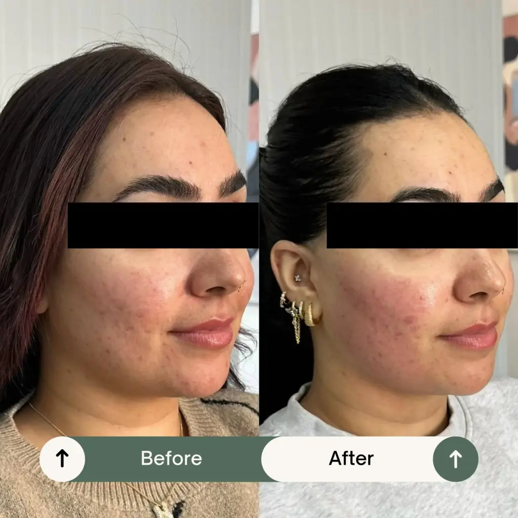 PRP before and after result 
