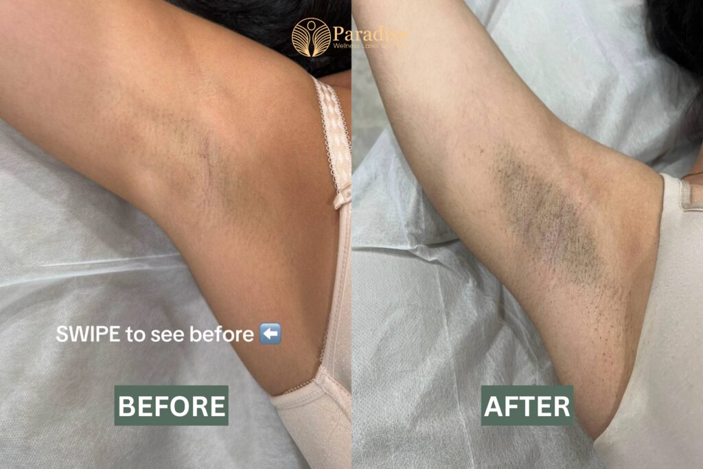 Underarm sweating treatment with Botox before and after results 2