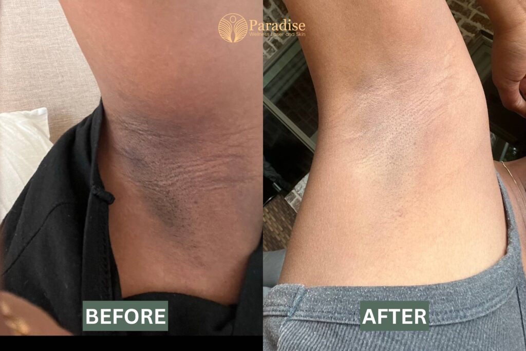Underarm sweating treatment with Botox before and after results