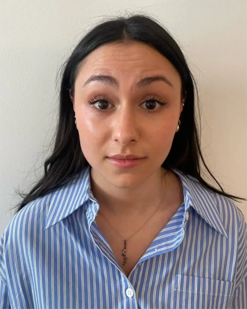 baby botox treatment result before image at paradise wellness