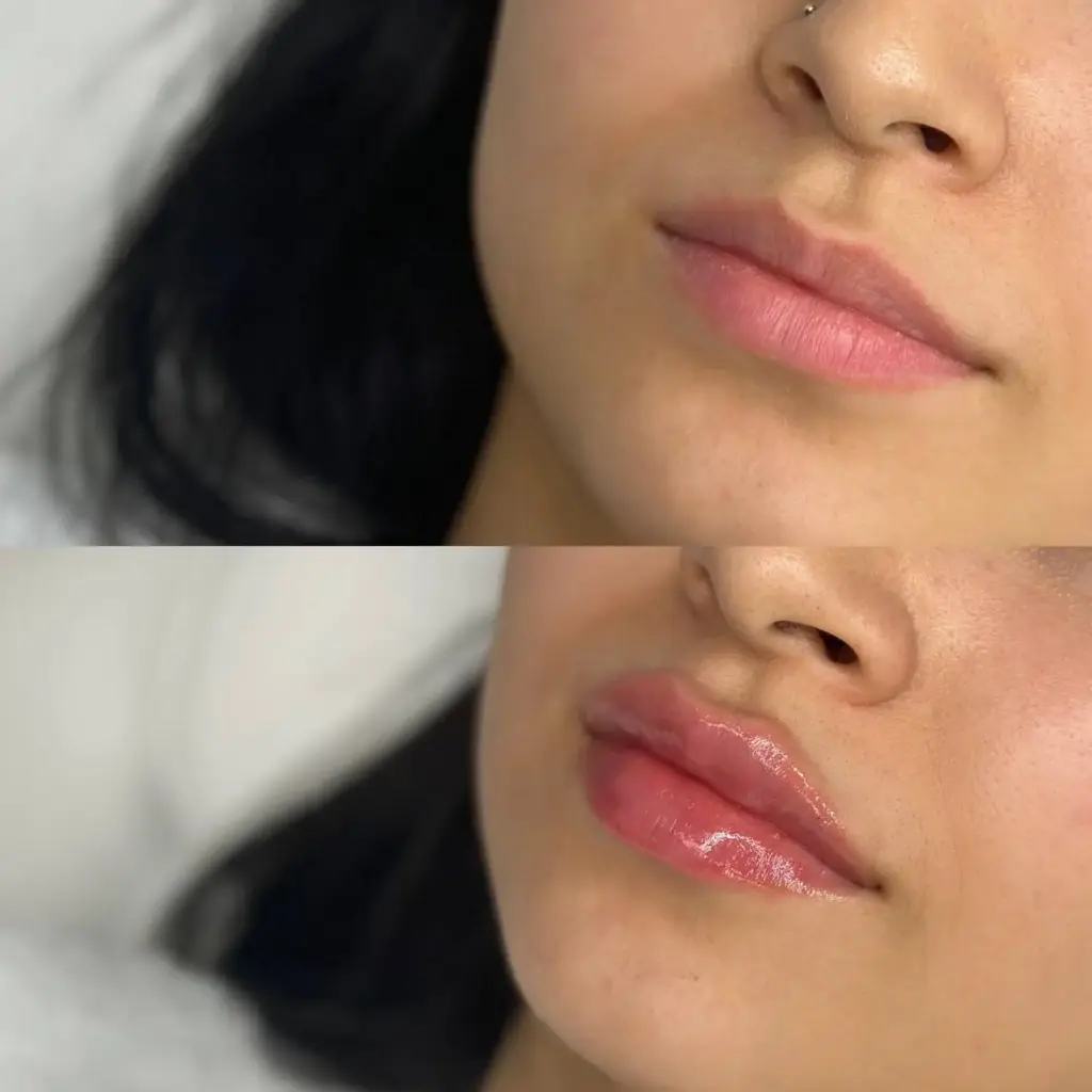 Before and after image of lip filler in Delhi showing natural enhancement and symmetry correction