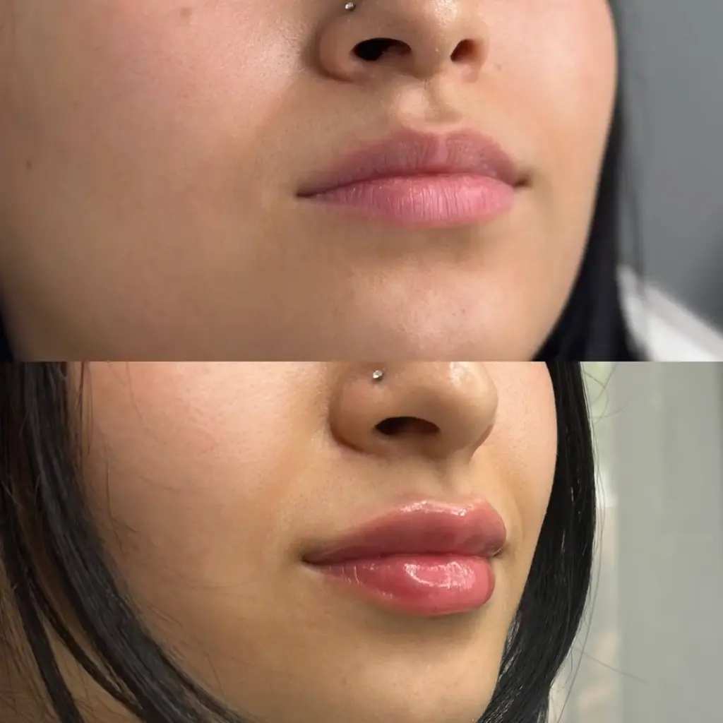 Before and after photos of lip filler in Delhi showing natural enhancement and symmetry correction