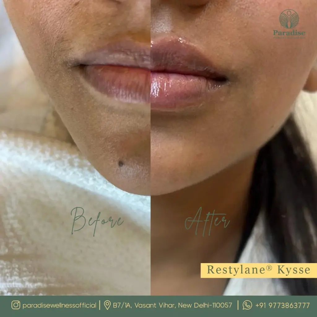 Before and after dermal fillers to restore cheek volume by Dr. Sharma at Paradise Wellness.