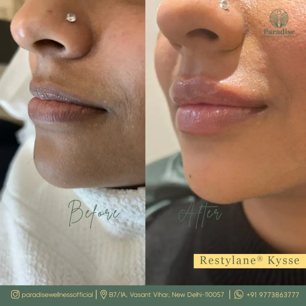 Before and after dermal fillers to restore cheek volume by Dr. Sharma at Paradise Wellness.