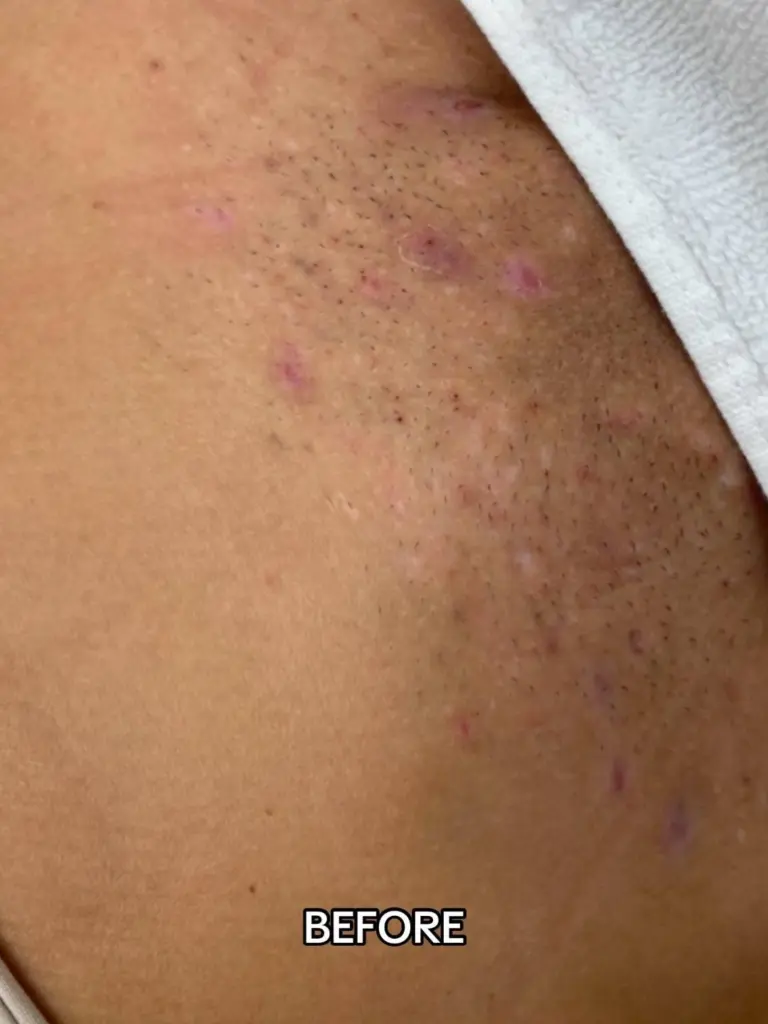  A side-by-side photo showing natural Bikini Laser Hair Removal results at Paradise Wellness.