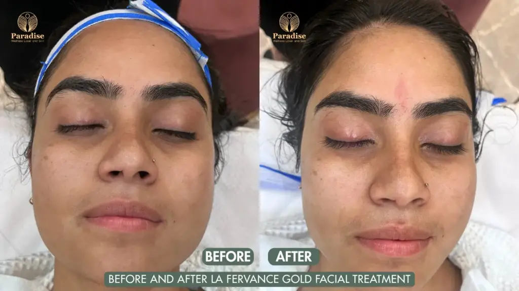 Before and After La Fervance Gold Facial Treatment at Paradise Wellness Delhi