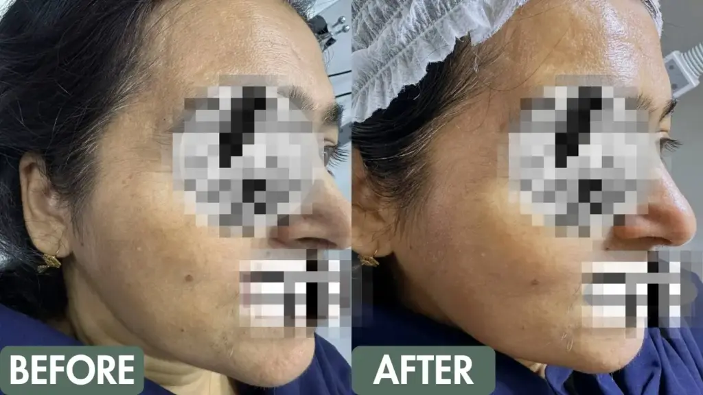 Bridal skin treatments in Delhi – before and after glowing bridal skin results at Paradise Wellness Clinic