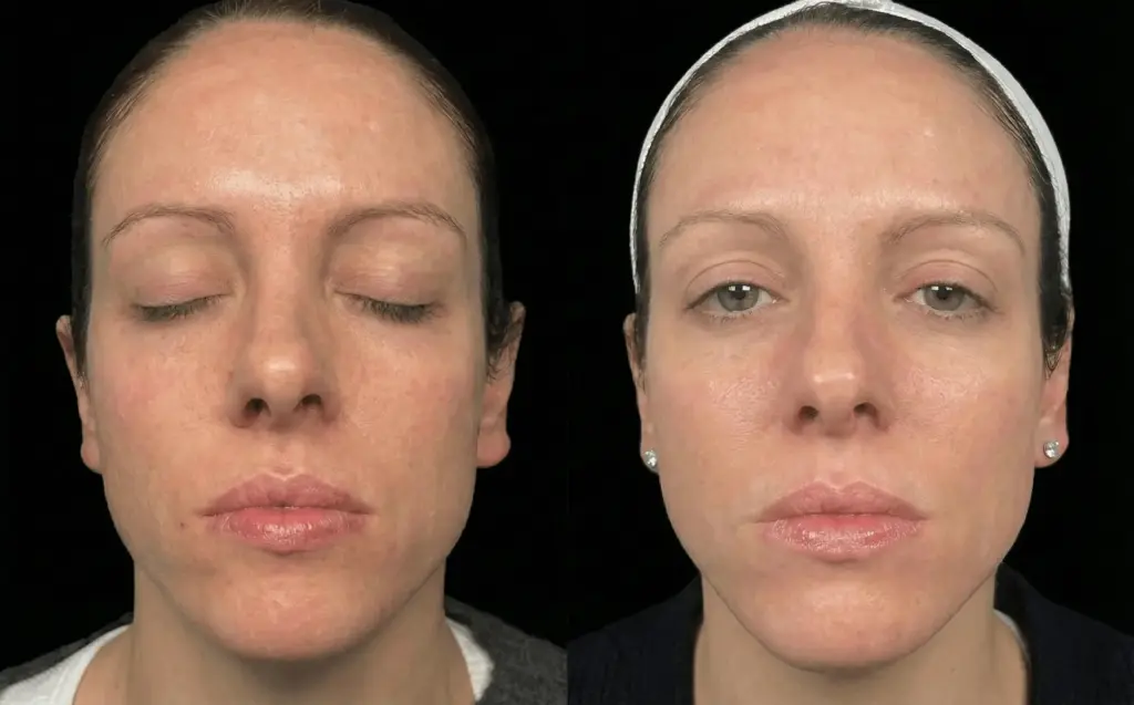 Aqua Gold Facial 24K Gold – glowing smooth glass skin results before after image
