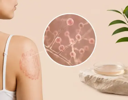skin fungus