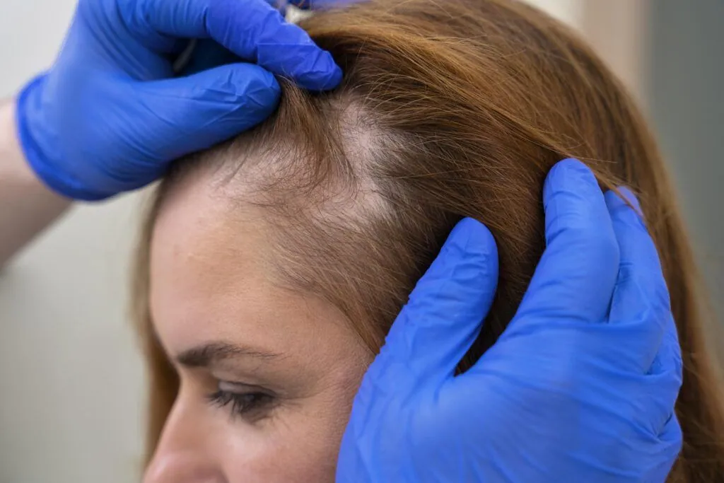 Alopecia Areata Treatment