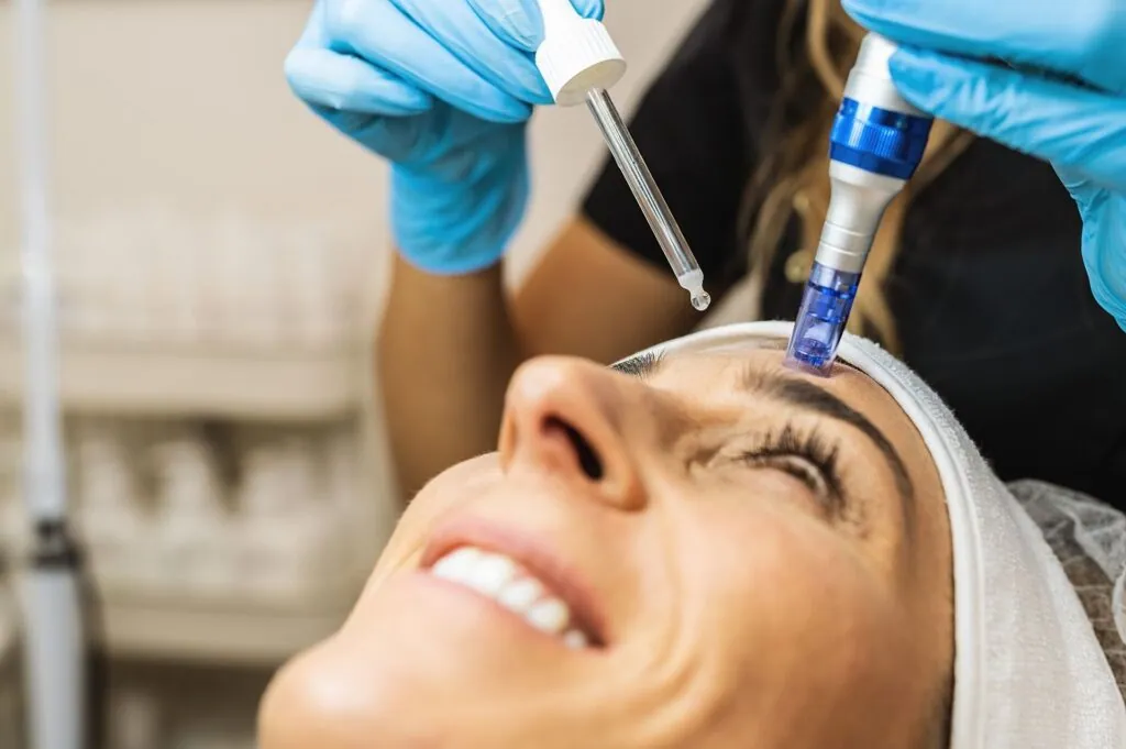 Microneedling for acne scars and pigmentation correction