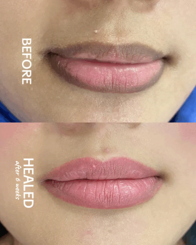 Before and After Pink Lip Treatment Single session