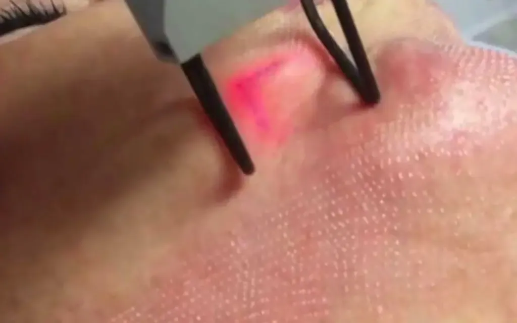 Fractional CO2 Laser