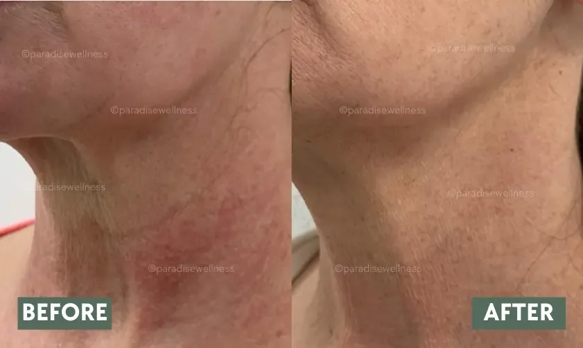 HIFU Face Treatment Before and After Results at Paradise Wellness Clinic Delhi