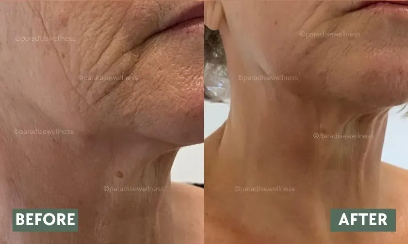 Non-surgical facelift with HIFU — jawline tightening before and after photo