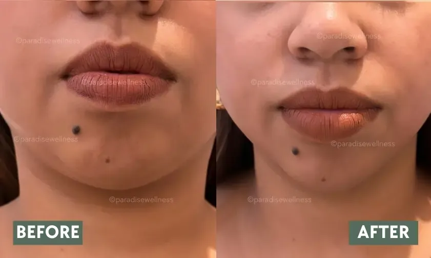HIFU Face Treatment results – lifted cheeks and neck area before & after