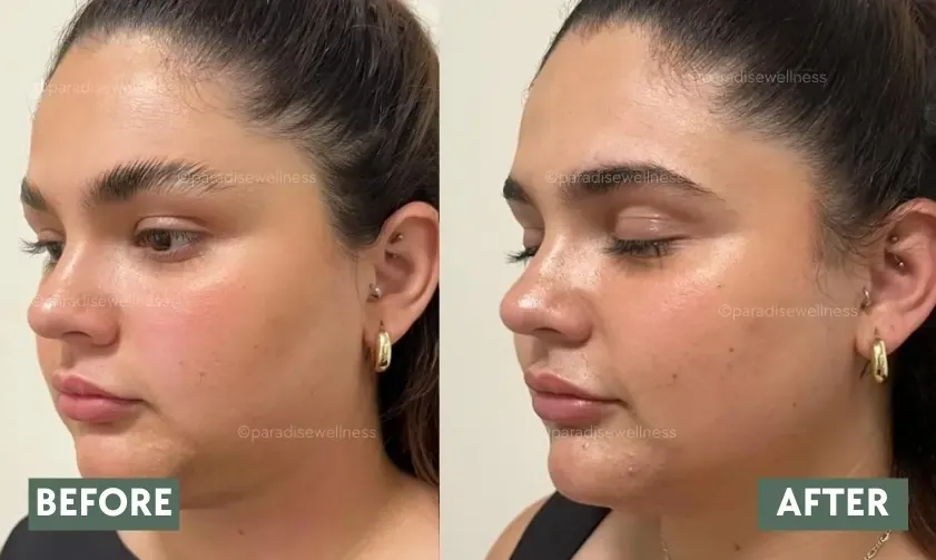 Client’s skin tightening before and after with HIFU Face Treatment Vasant Vihar