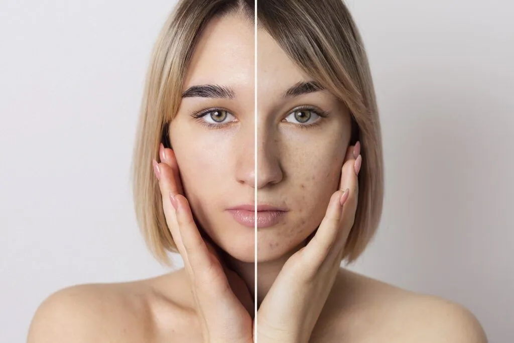 Matcha Facial Before and After Results for Acne and Dull Skin