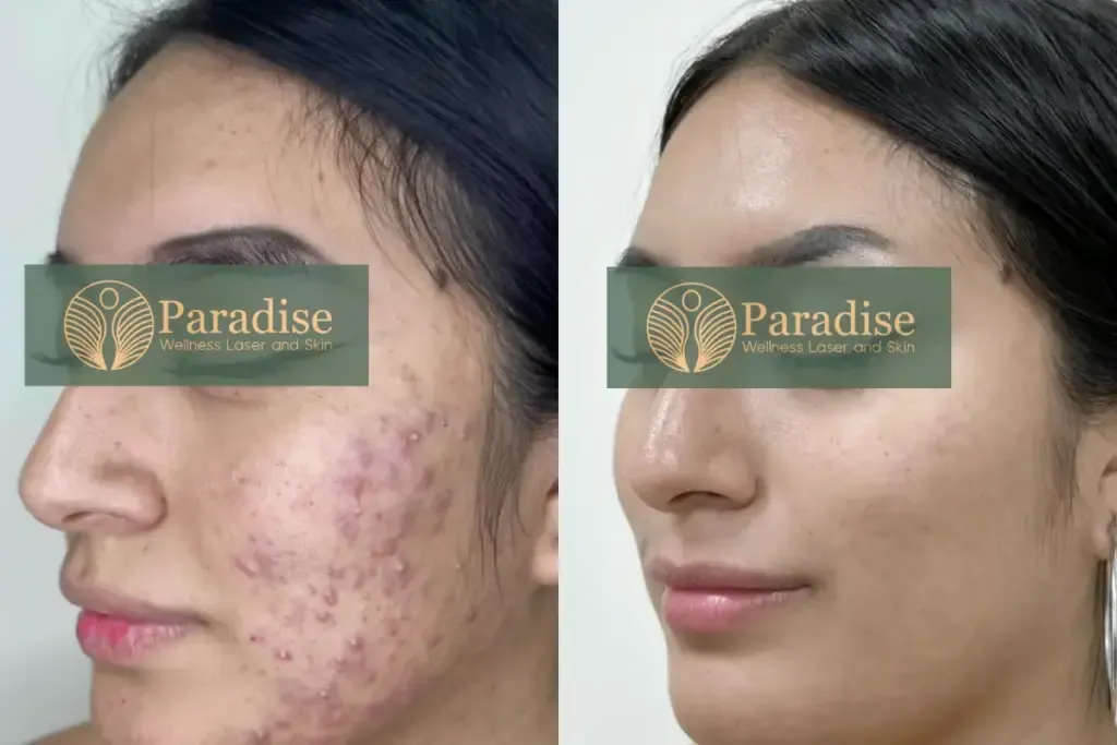 best acne treatment in Delhi Before after image client