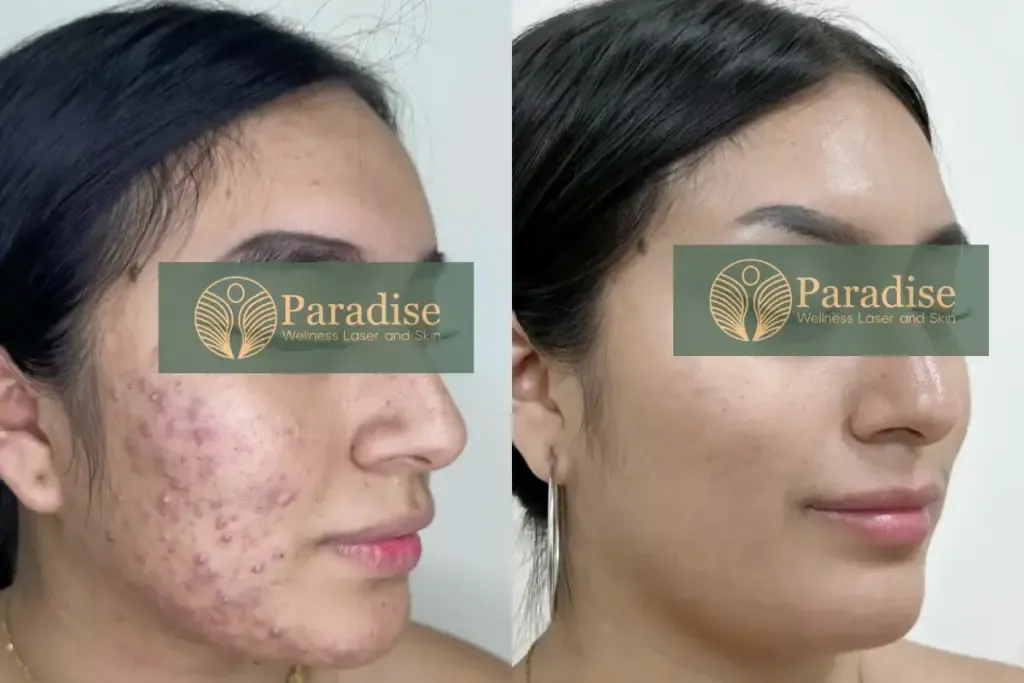 Before and After Acne Treatment at Paradise Wellness