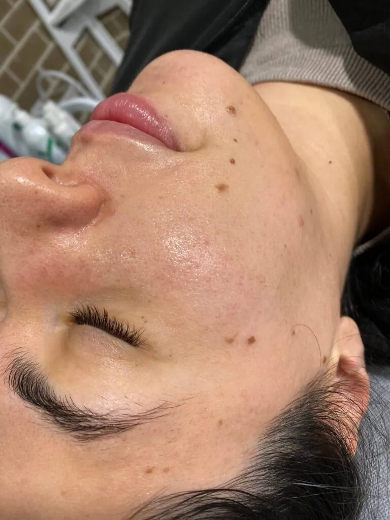 Open Pores Reduction Results with Laser and Chemical Peel