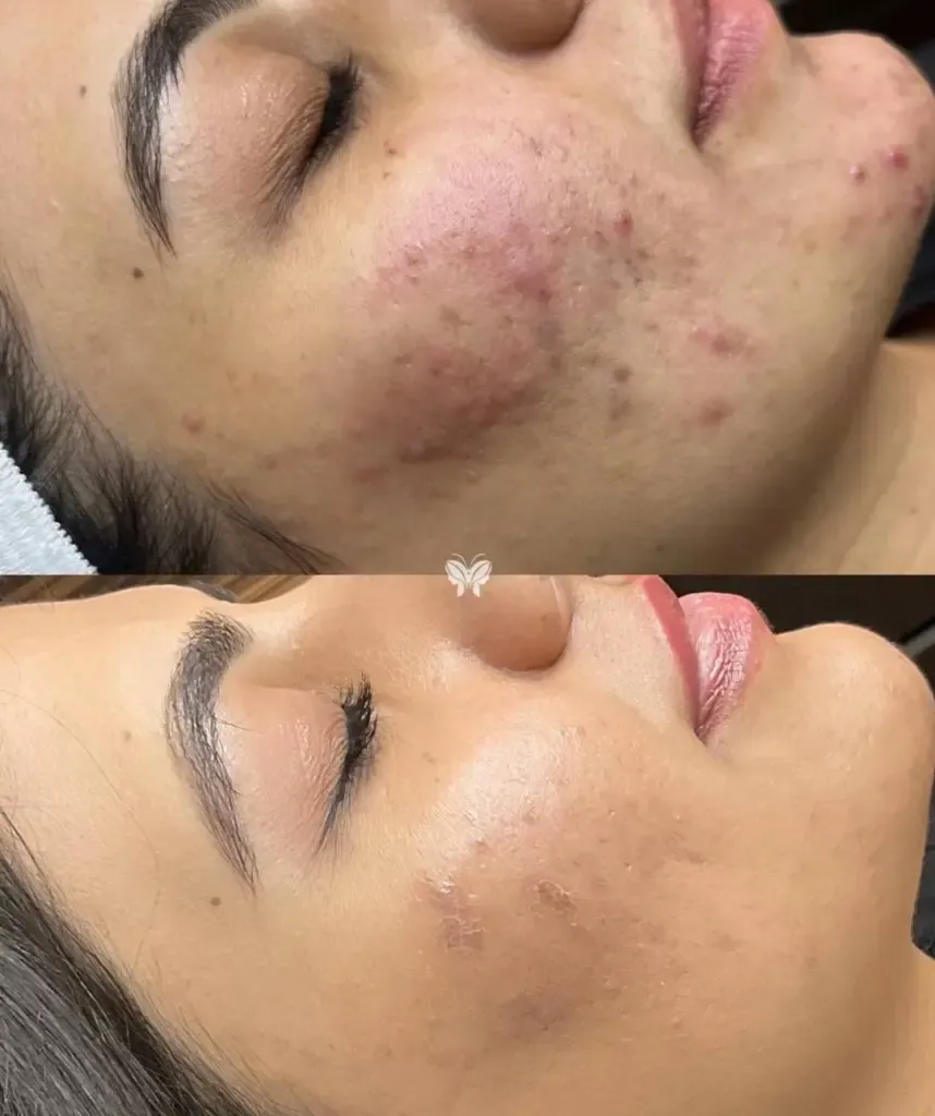 Before and After ExoCoBio Exosome ASCE Plus SRLV Treatment at Paradise Wellness
