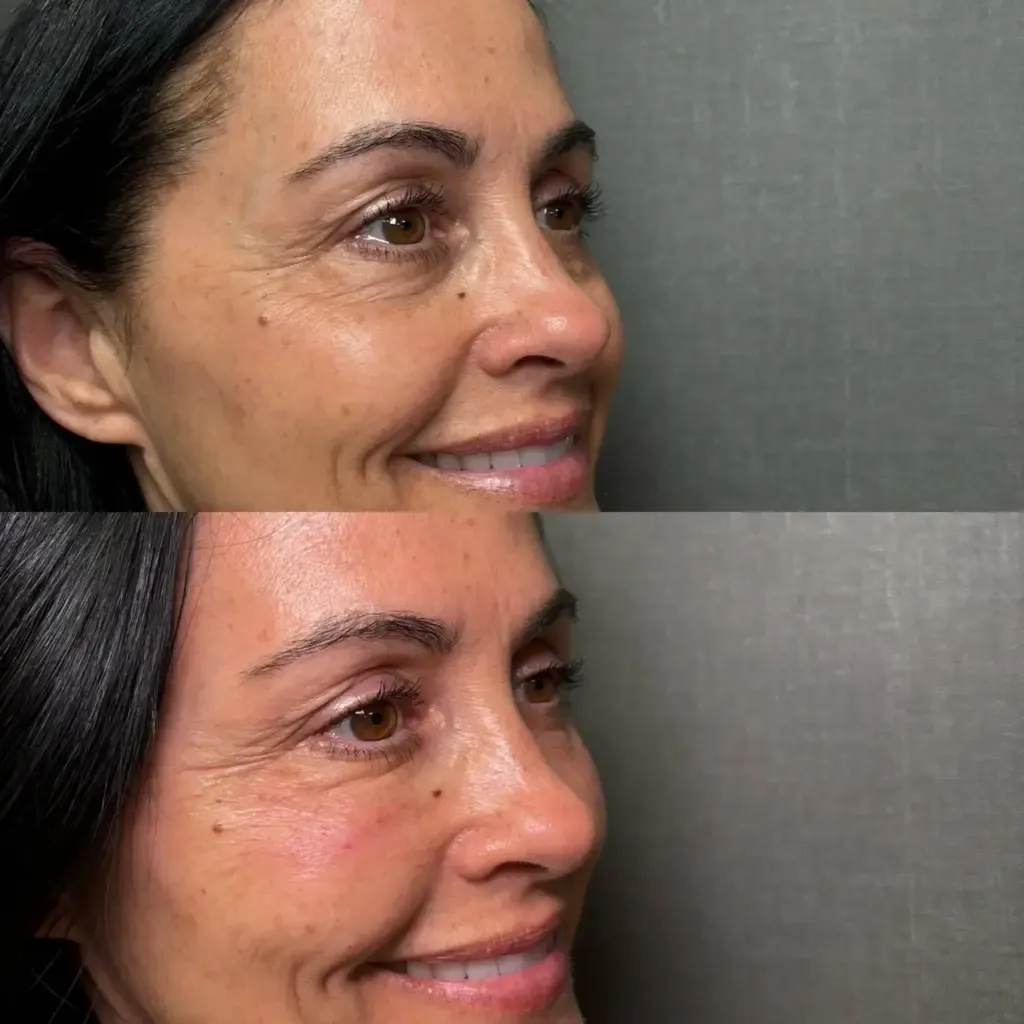 Before and After Microneedling with Exosomes Treatment at Paradise Wellness