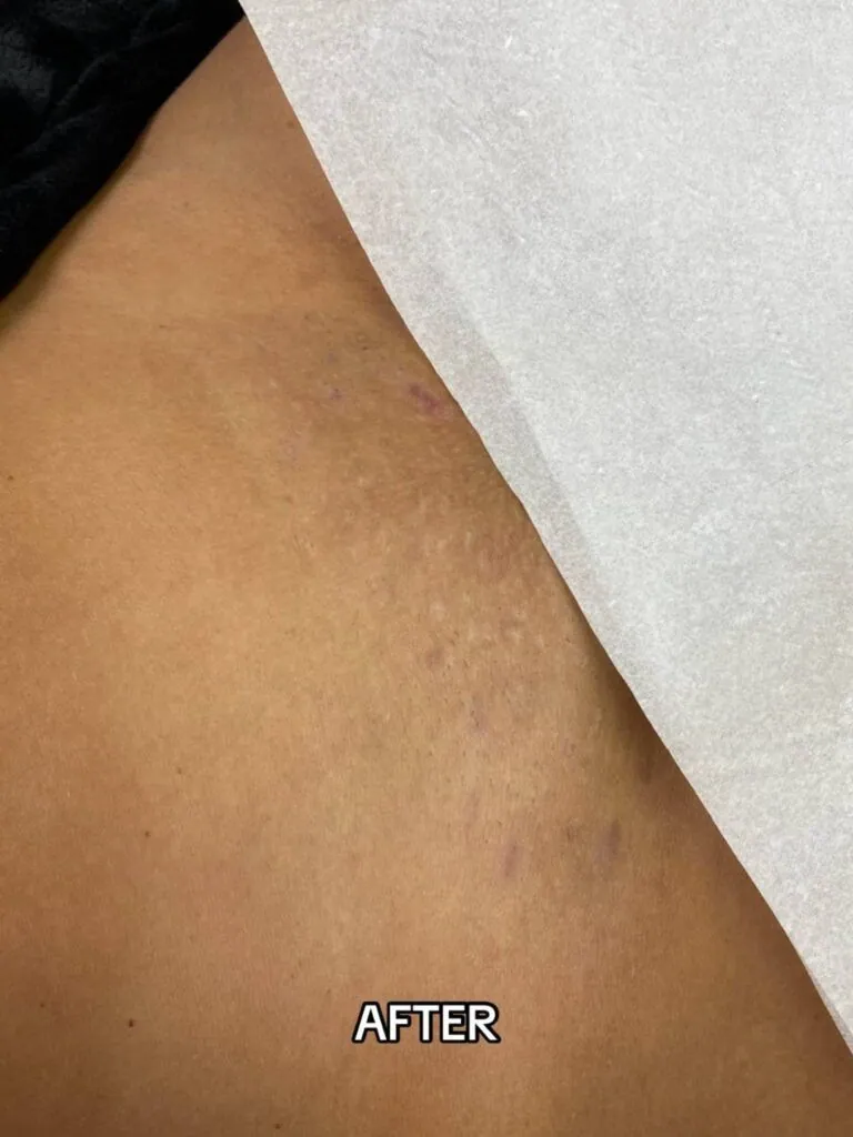 After Laser Hair Removal Side Effects on Bikini Area at Paradise Wellness