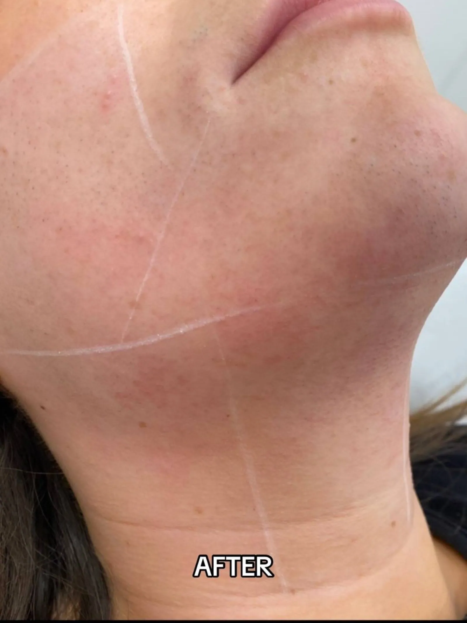 Chin laser after pic 1 scaled
