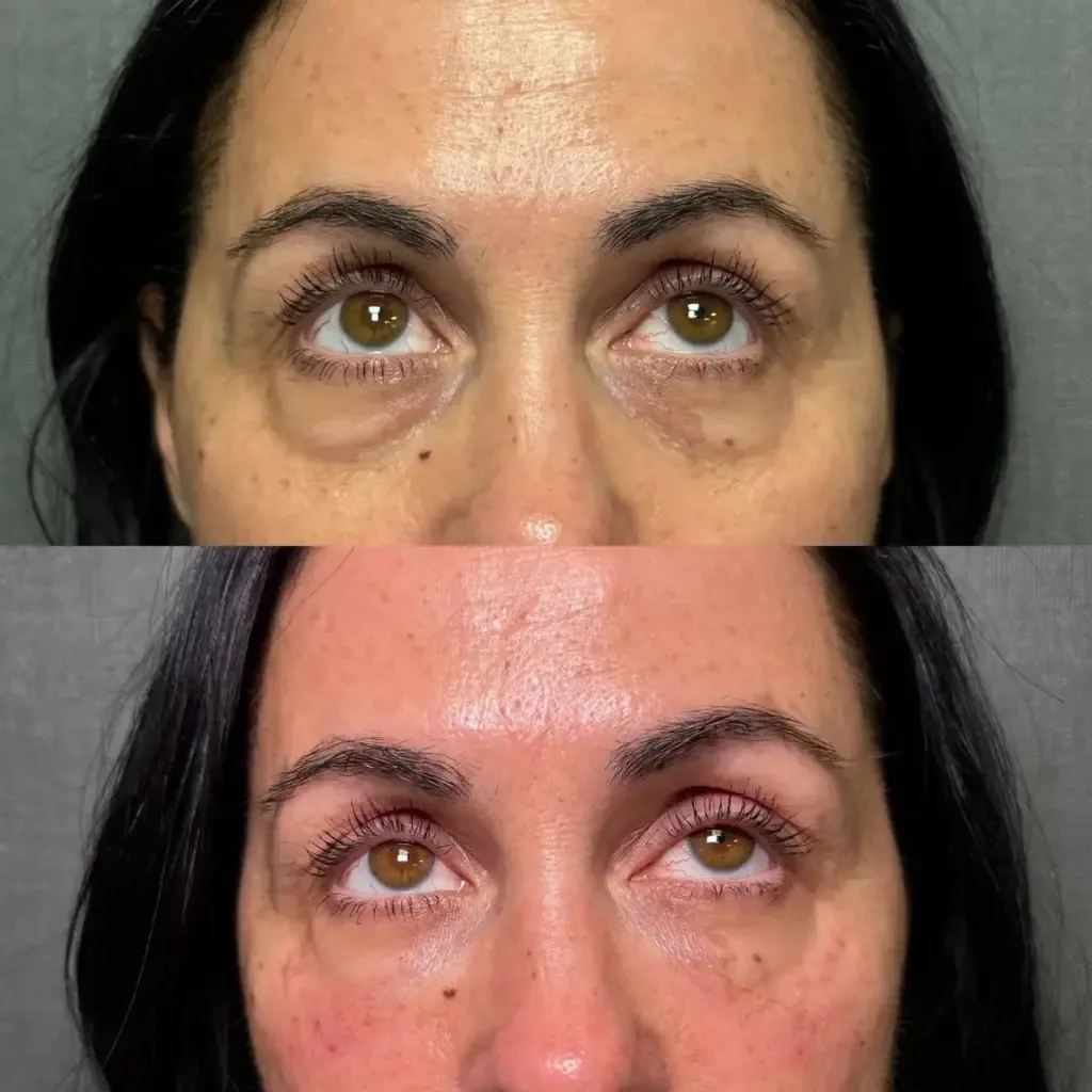 Microneedling with Exosomes Before and After Results – Smooth and Youthful Skin
