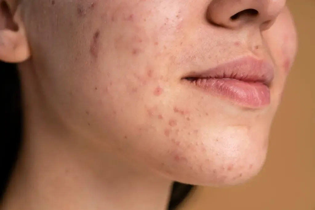 Oily skin in monsoon tips