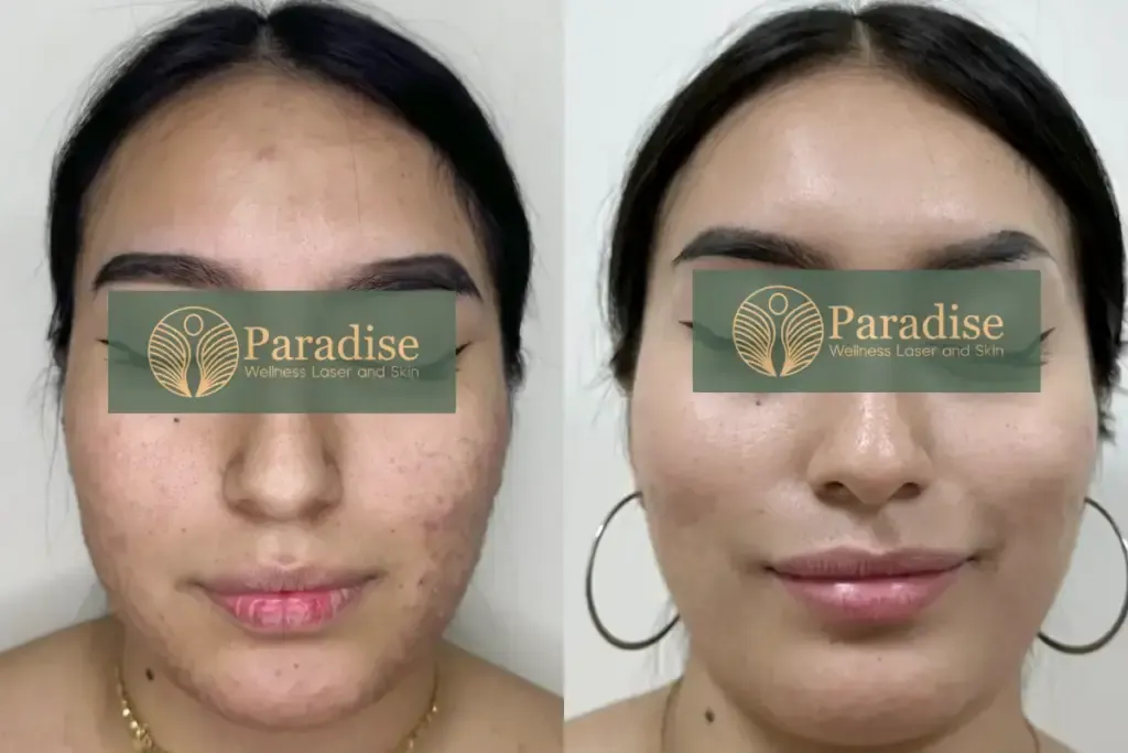 Acne Scar Removal Before and After at Paradise Wellness Clinic