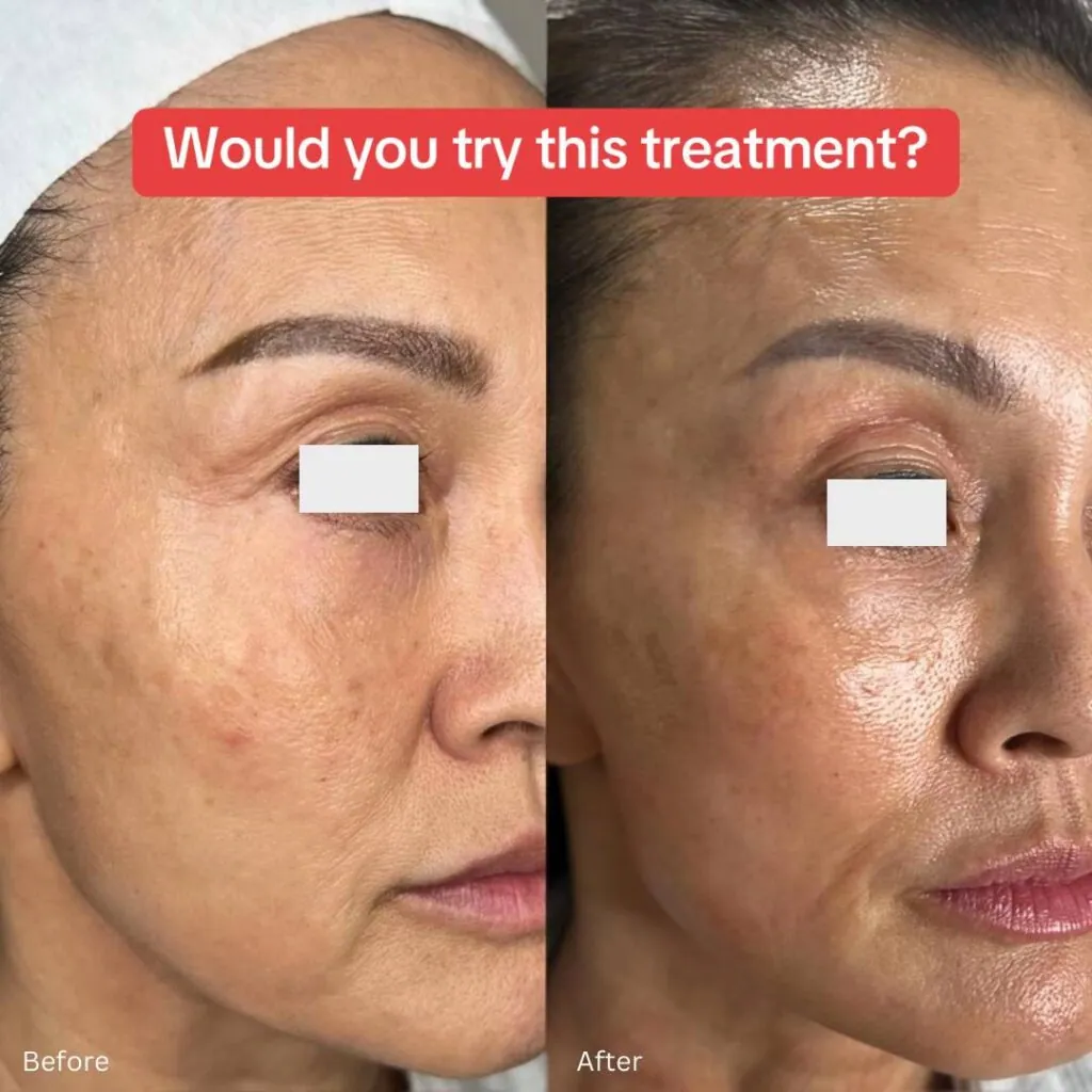 Before and After Salmon Sperm Treatment at Paradise Wellness