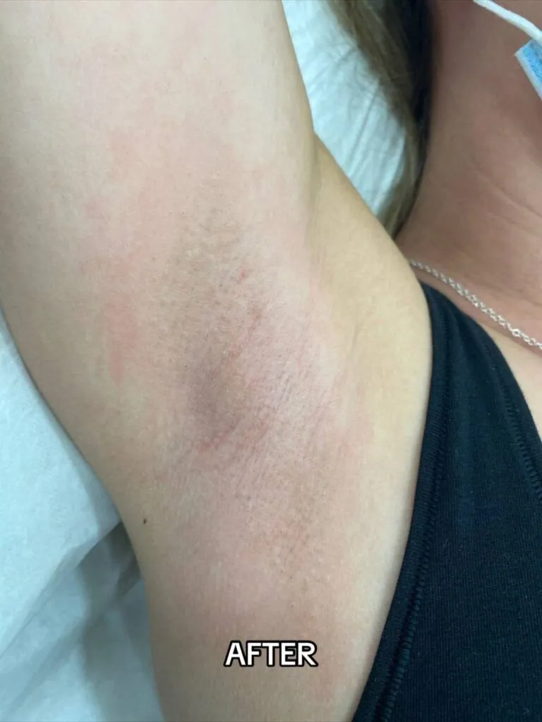 After Laser Hair Removal Side Effects Treatment at Paradise Wellness - Underarm