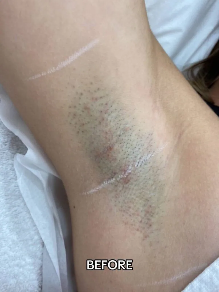 Before Laser Hair Removal Side Effects Treatment at Paradise Wellness - Underarm